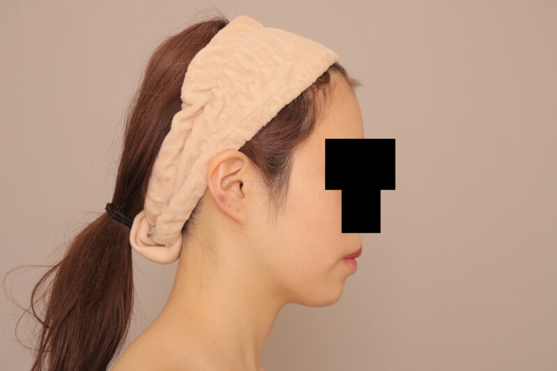 頬顎脂肪吸引でまっすます美人さんに♡20代モニター様半年後