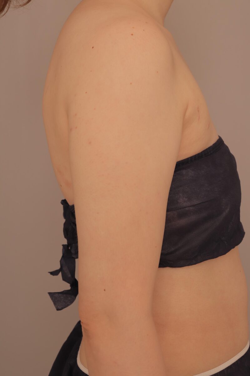 結婚式に向けて二の腕肩、脇肉の脂肪吸引を!モニター様半年後