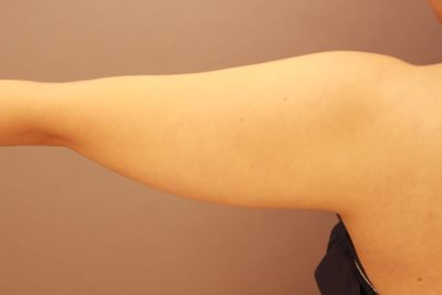 二の腕の脂肪吸引 半年経過