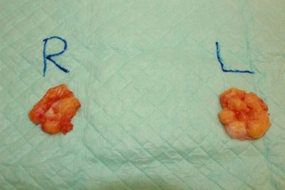 女性化乳房　３か月後経過