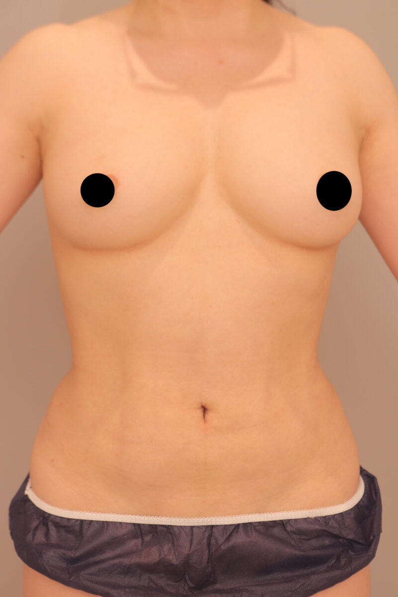 みんなで目指そう峰不二子♪50代モニター様のお腹全体胸下腰の脂肪吸引からのコンデンスリッチ豊胸1年後