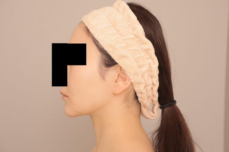 頬顎脂肪吸引でフェイスラインくっきり!モニター様半年後