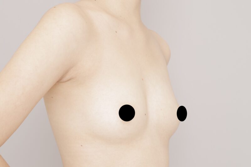 ベイザー脂肪吸引（6か月経過：27）の術前写真