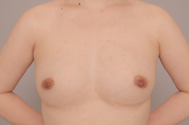 二の腕、脇肉吸引からのコンデンスリッチ豊胸♡モニター様6ヶ月後♪