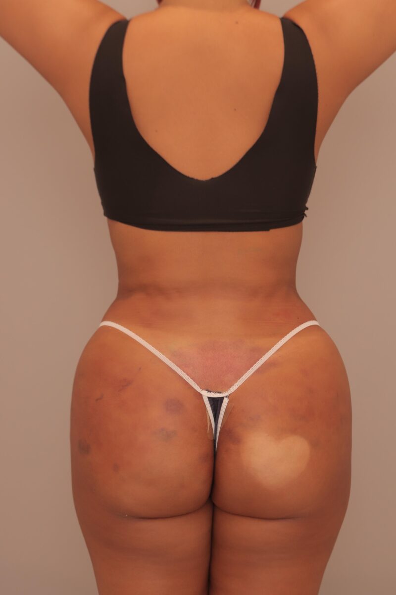 ブラジリアンバットリフトのモニター様翌日の様子♡