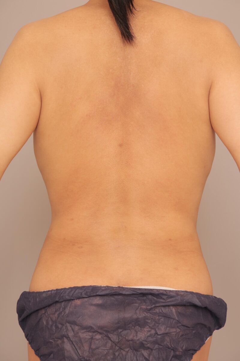 女性らしいボディラインになりたい男性の腹腰脂肪吸引の変化3か月後