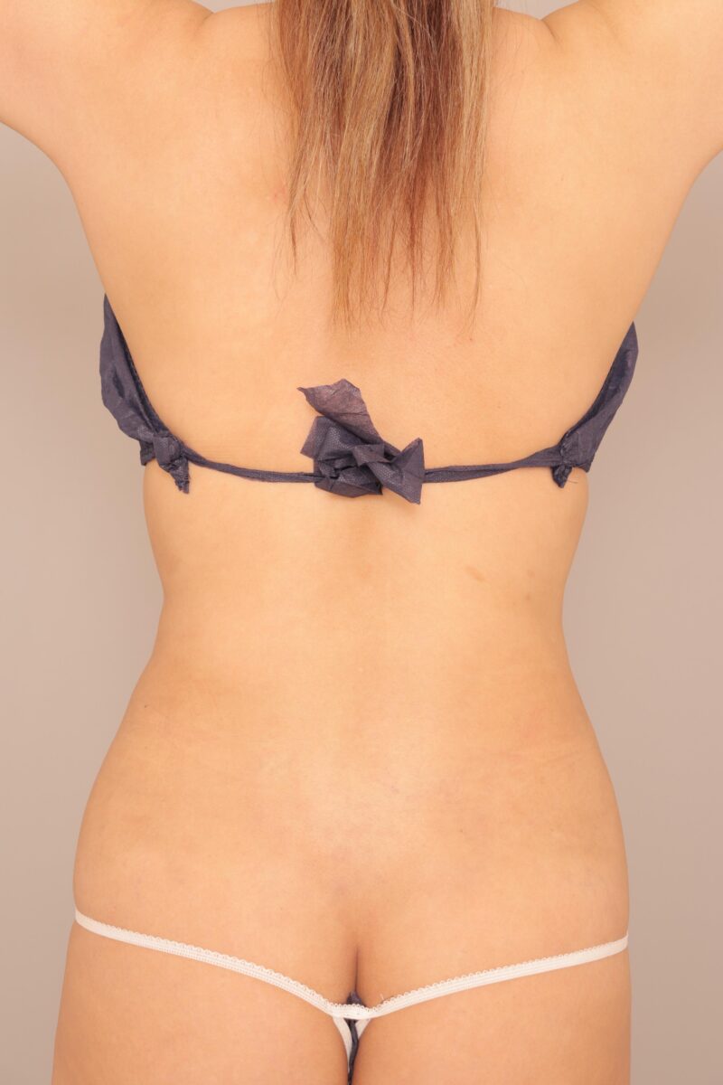 旦那様も大喜び♡腹腰の脂肪をバストとヒップにお引越ししたモニター様1ヶ月後♪