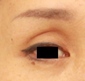 目の上の窪み　マイクロCRF注入