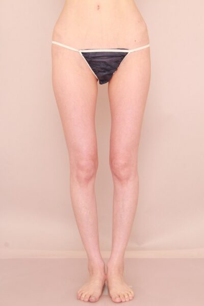 こんなに痩せていてもコンデンスリッチ豊胸は出来ます。