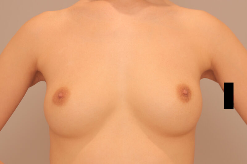 昨日の方のバストの変化♡