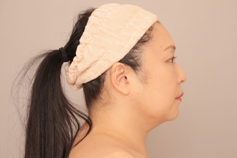 顎下のみの脂肪吸引の50代顔出しモニター様3ヶ月後