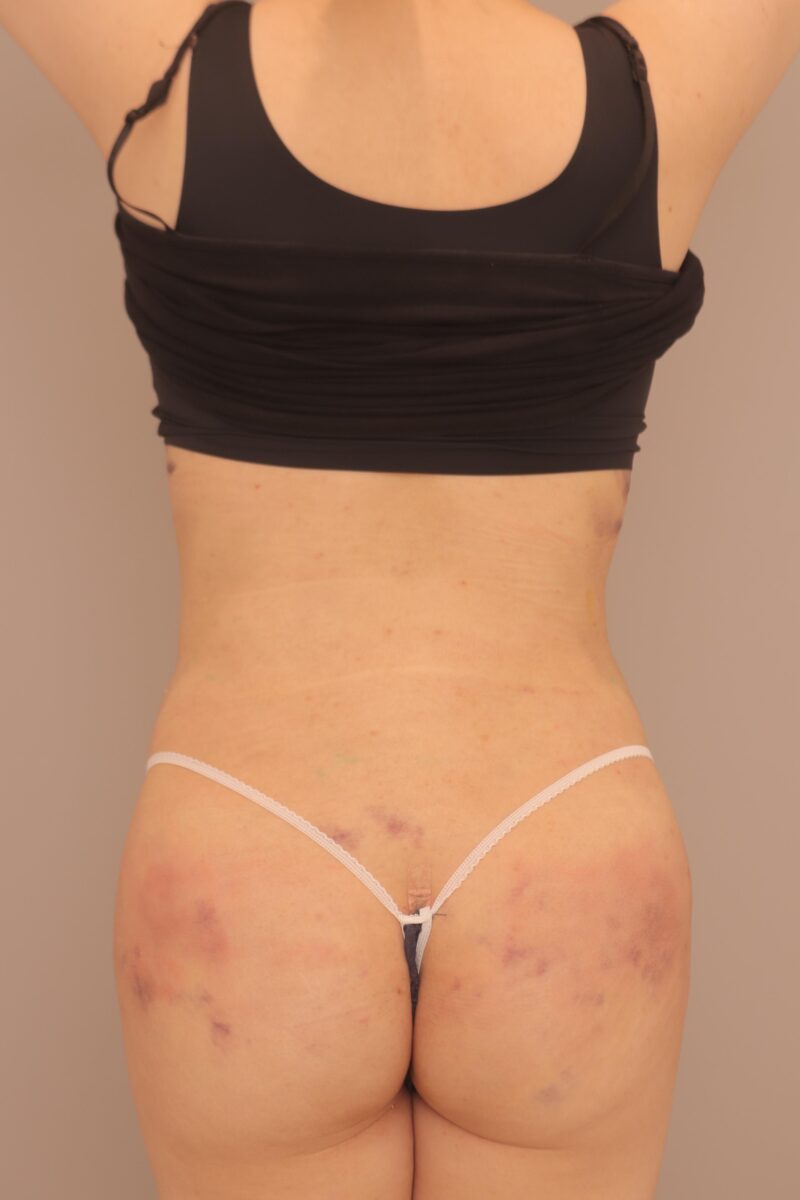 ブラジリアンバットリフトでママさんの長年のコンプレックス解消!