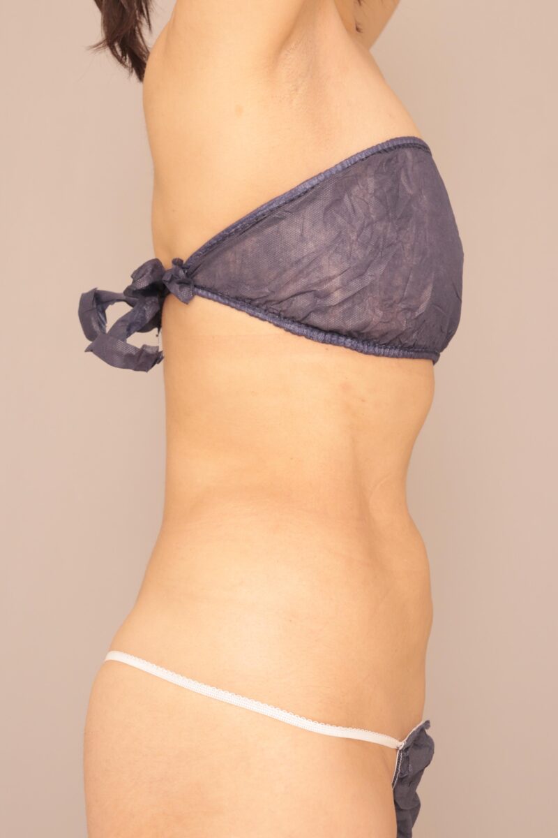 （お傷はおヘソのみ！！）64歳のモニター様お腹全体胸下腰の脂肪吸引半年後♡