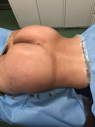 ブラジリアンバッドリフトのコツ