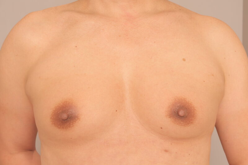 元男性(ホルモン治療あり)の53歳モニター様バストの変化3ヶ月後
