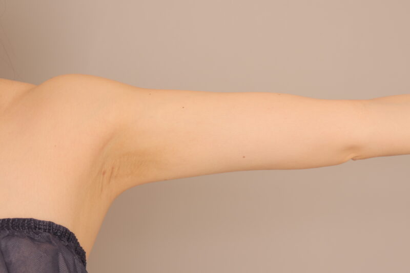二の腕肩の脂肪吸引