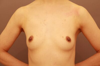 コンデンスリッチ豊胸３か月経過