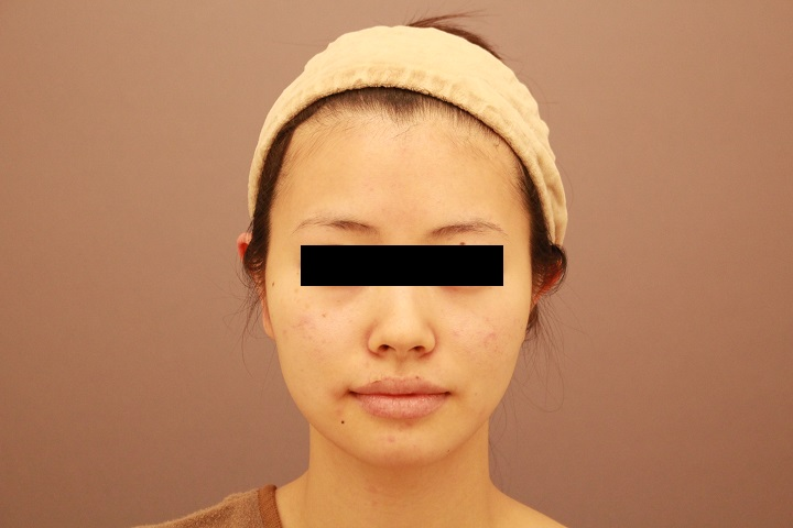 顔の脂肪吸引 まとめ