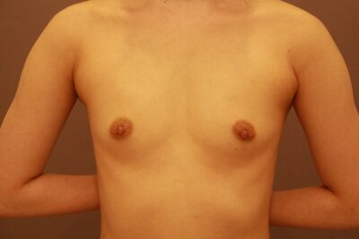 コンデンスリッチ豊胸を３回して５年後