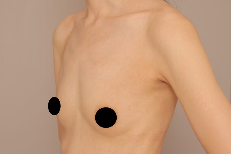 痩せ型の方のコンデンスリッチ豊胸3ヶ月後♡