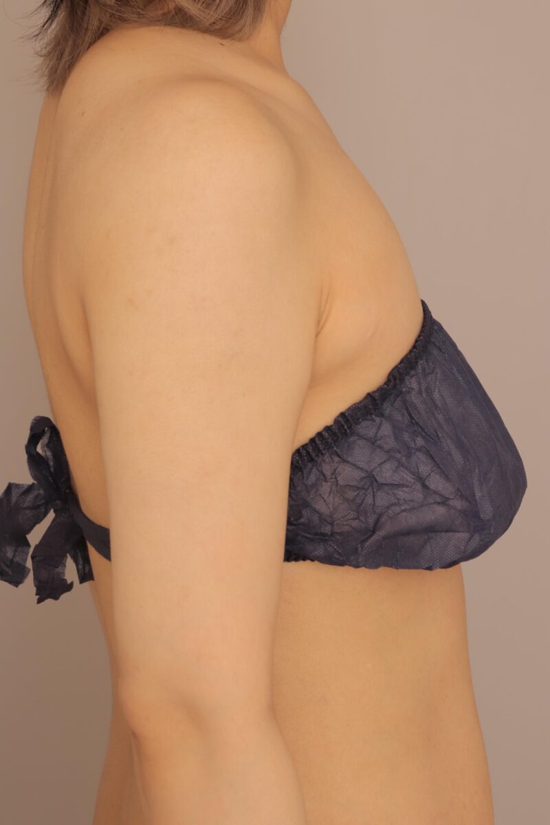 二の腕、肩の脂肪吸引でスラッと華奢ラインに♡半年後