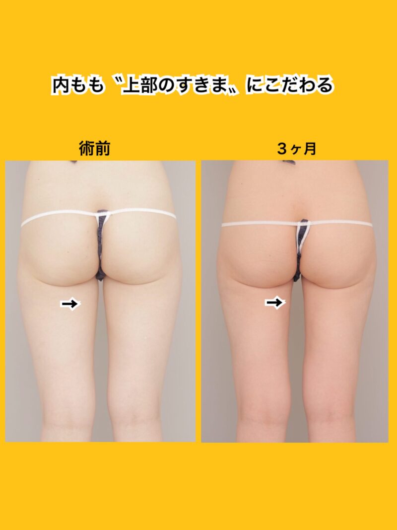 太もも上部のすきま。お任せください　～33歳160cm54kg大腿全周3400cc吸引後3ヶ月～