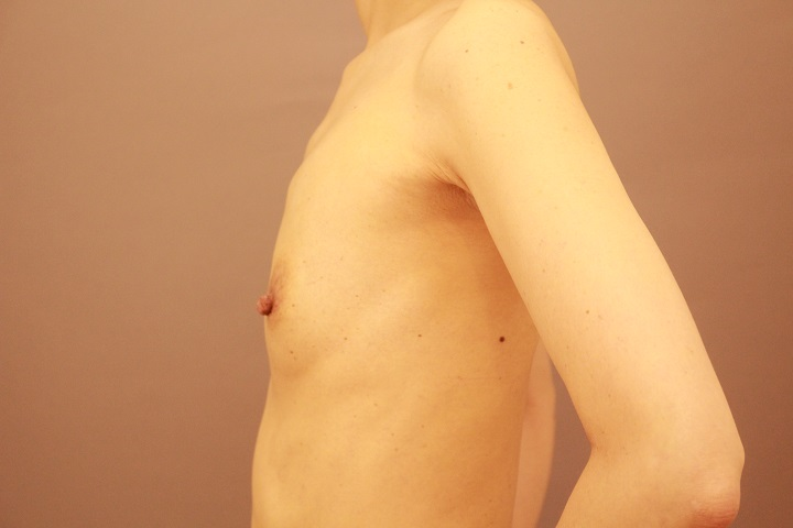 コンデンスリッチ豊胸と乳頭縮小　３か月経過