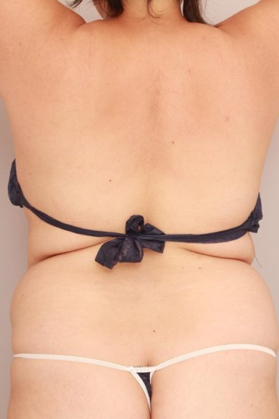 背中の脂肪吸引 翌日経過