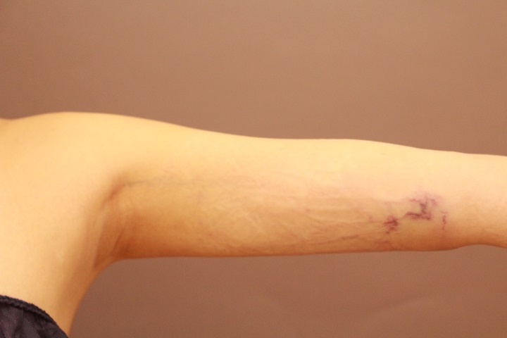 二の腕・肩 翌日の内出血の状態