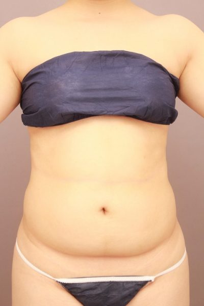 お腹の脂肪吸引 半年経過