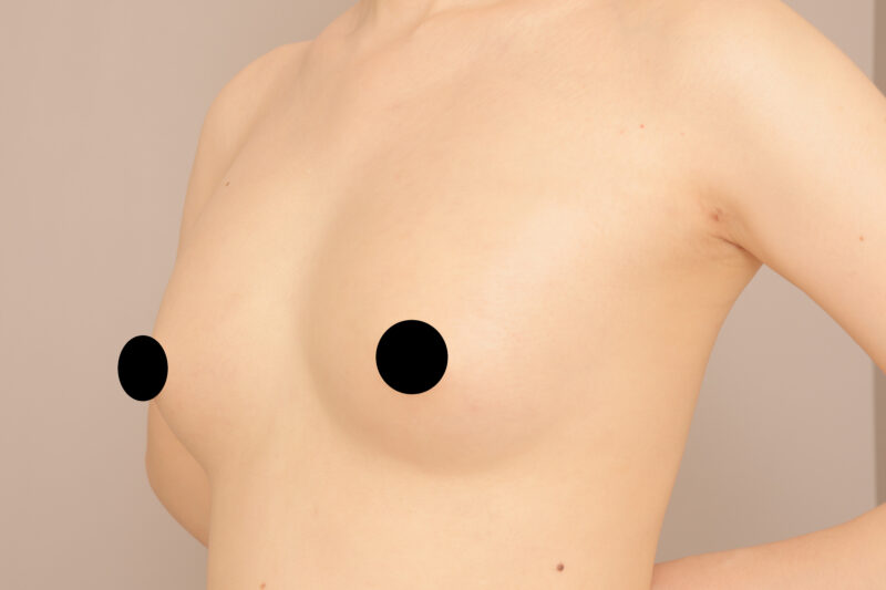 33歳コンデンスリッチ豊胸で別人のバストに♡太ももの脂肪をお引越し3ヶ月後