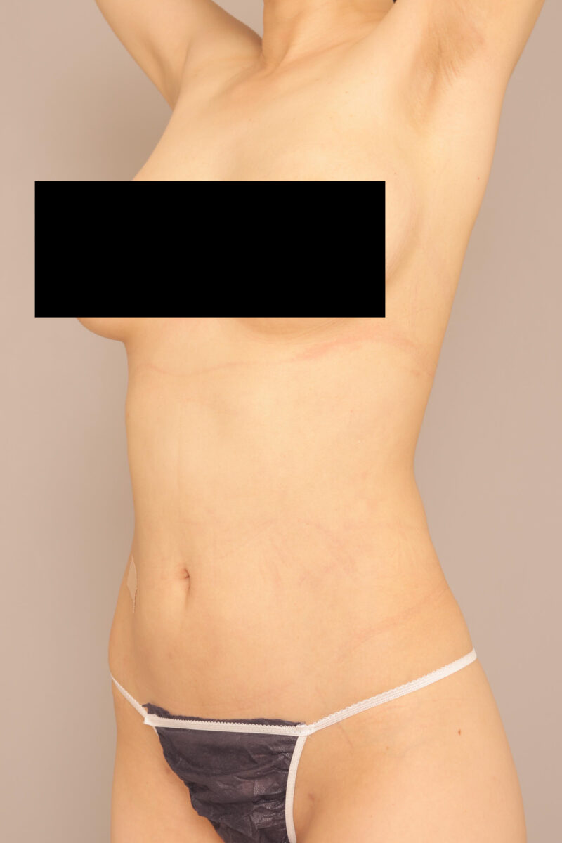 お腹全体胸下腰の脂肪吸引3ヶ月後