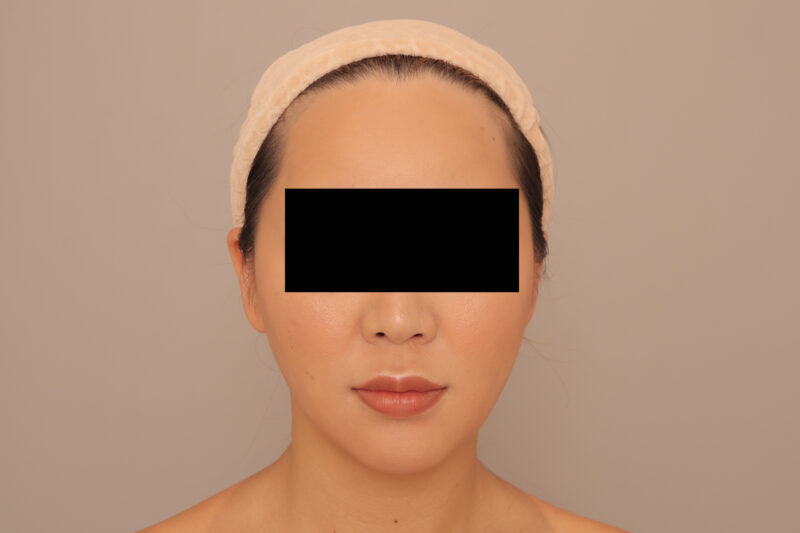 ほほ顎脂肪吸引で洗練された印象に♡30代モニター様半年後