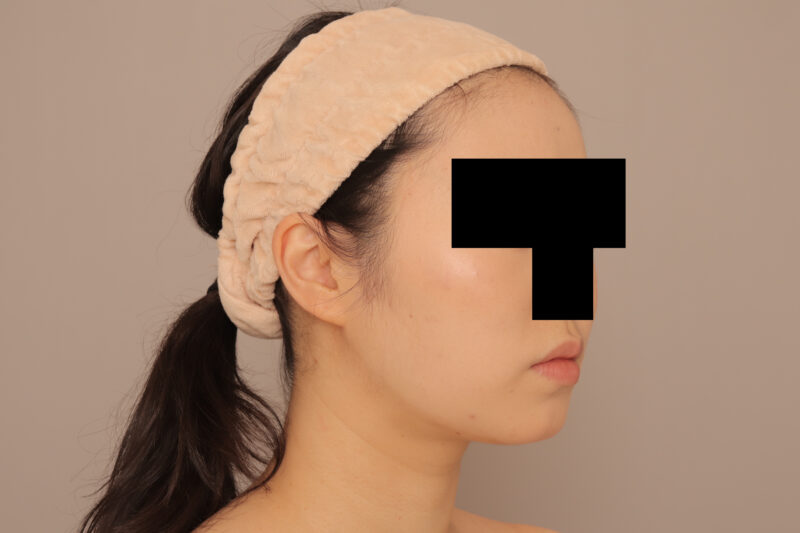 お顔の左右差を改善し垢抜けた印象に♡20代ほほ顎脂肪吸引3ヶ月後