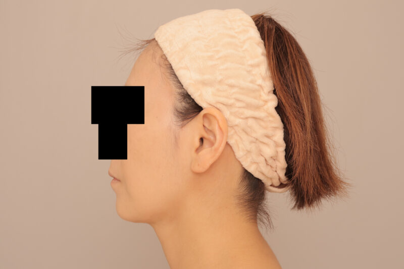 ほほ顎脂肪吸引3ヶ月後♡