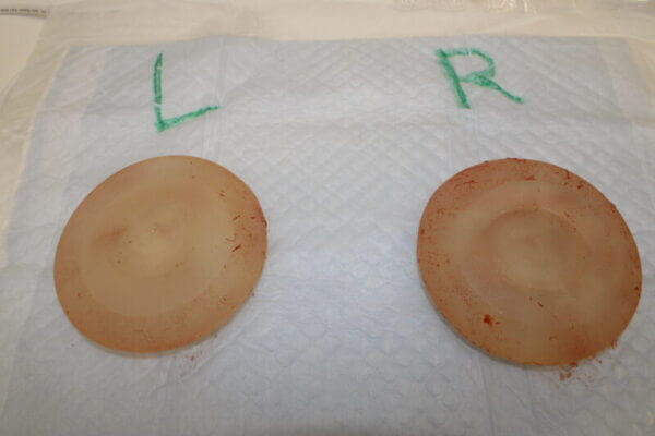 抜去したシリコンバッグ