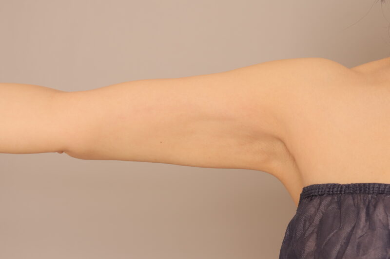 前回のモニター様の二の腕の変化3ヶ月後