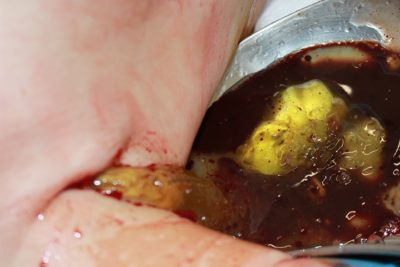 破損しているシリコンバックを抜去してコンデンスリッチ豊胸