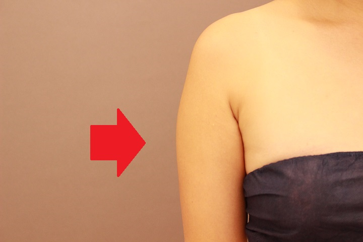 二の腕・肩の脂肪吸引 半年経過