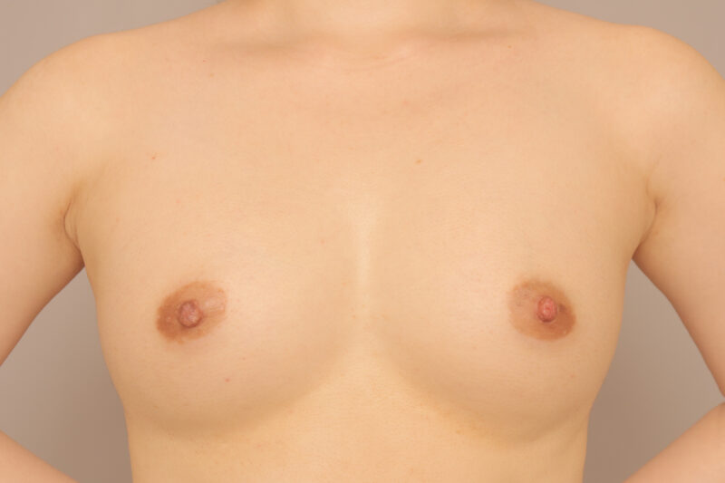 コンデンスリッチ豊胸でふっくら美バストに♡モニター様3ヶ月後♪