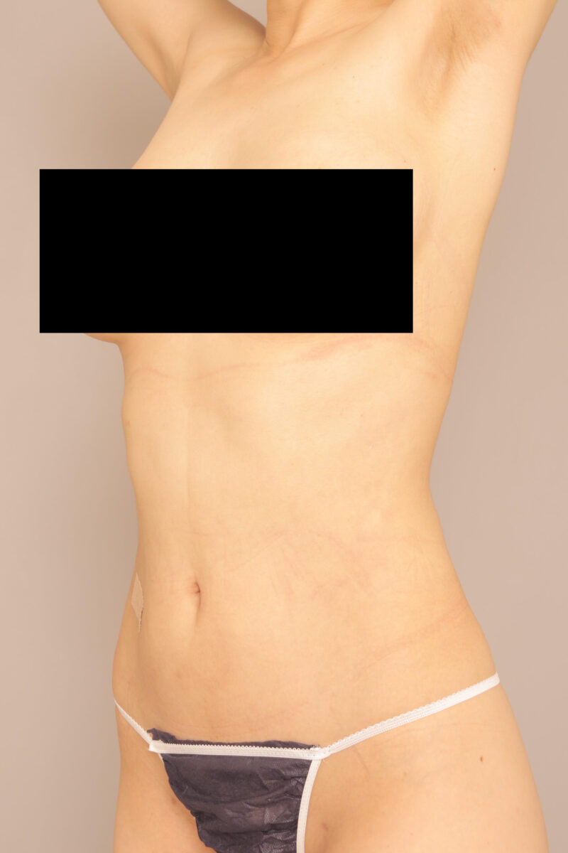 お腹全体胸下の脂肪吸引3ヶ月後