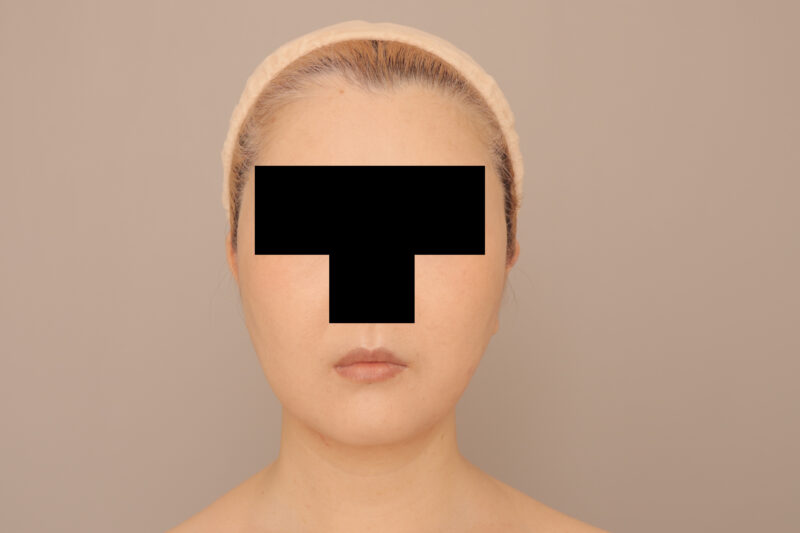 44歳モニター様ほほ顎脂肪吸引で逆卵型の輪郭に♡