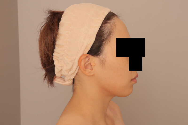 ほほ顎脂肪吸引でまっすます美人さんに♡モニター様半年後