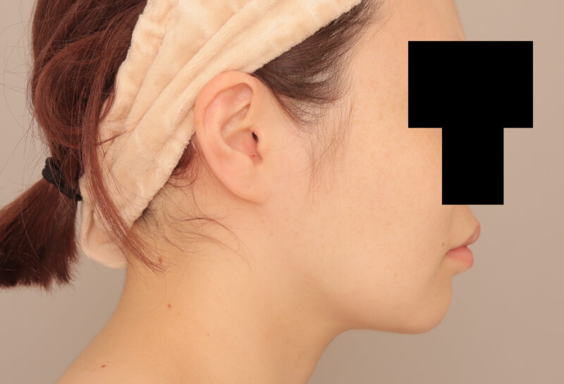 ほほ顎脂肪吸引でフェイスラインくっきり!!20代モニター様半年後