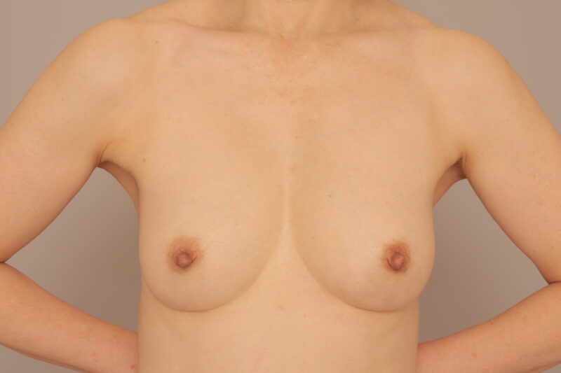 54歳コンデンスリッチ豊胸のモニター様1ヶ月後