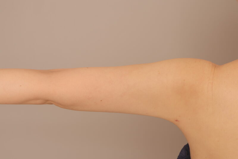 44歳二の腕肩の脂肪吸引モニター様1ヶ月後