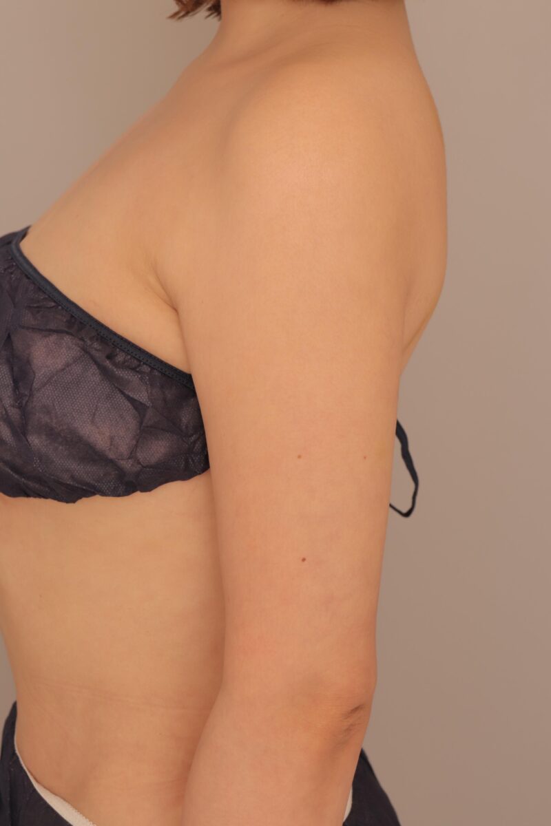 二の腕肩脇肉の脂肪吸引3ヶ月後♡