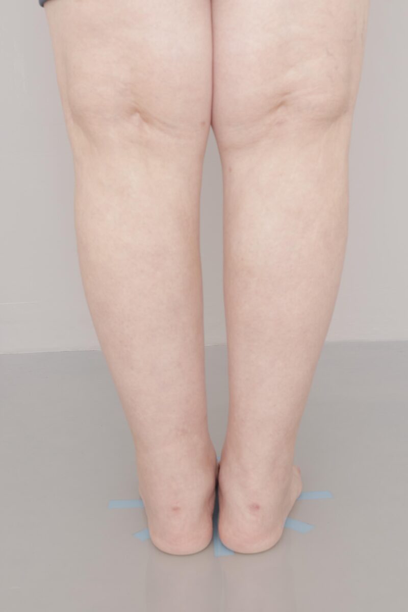 ふくらはぎから1,400cc吸引できました！ ６ヶ月経過～60歳, 162cm, 74.7kg～