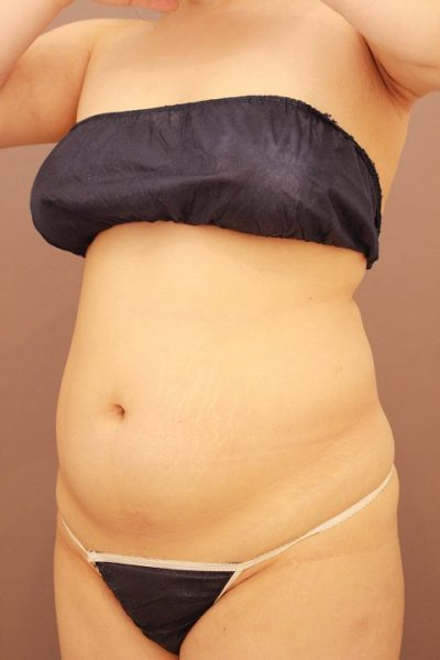 お腹の脂肪吸引 まとめ