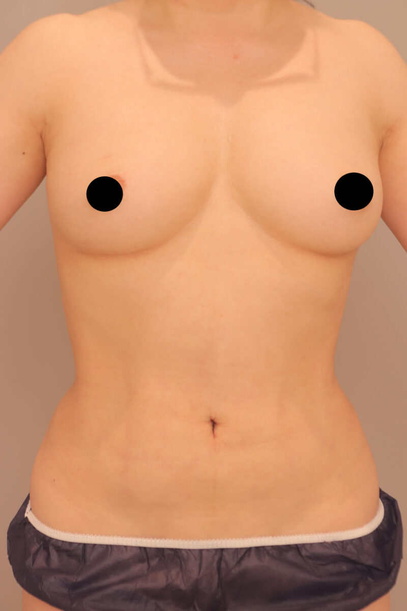 50代モニター様みんなで目指そう峰不二子♡お腹腰脇肉の脂肪吸引からのコンデンスリッチ豊胸♪